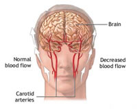 TIA transient ischemic attack
