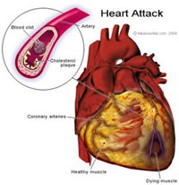 Life insurance heart attack