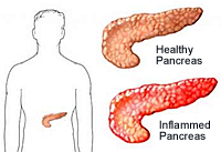 life insurance rates with pancreatitis