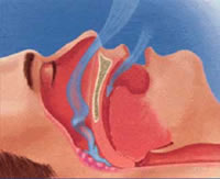 sleep apnea treatment options