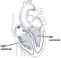 life insurance with irregular heart beats